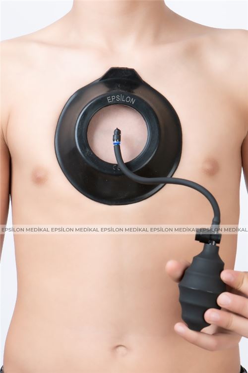 Pectus Vakum fotoğraf 5